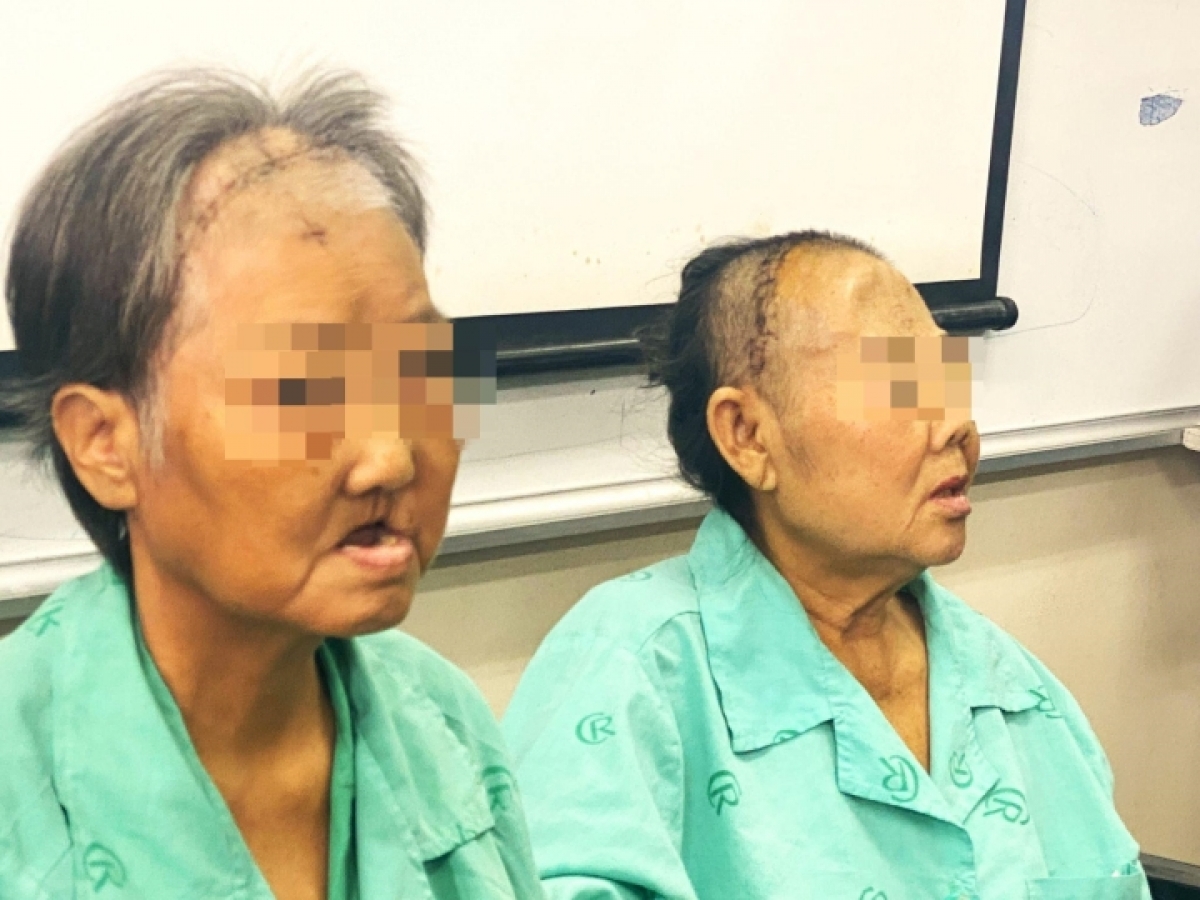 hoại tử xương hàm sau covid-19 bác sĩ phân tích nguyên nhân hình ảnh 1 hoai tu xuong ham sau covid-19 bac si phan tich nguyen nhan hinh anh 1