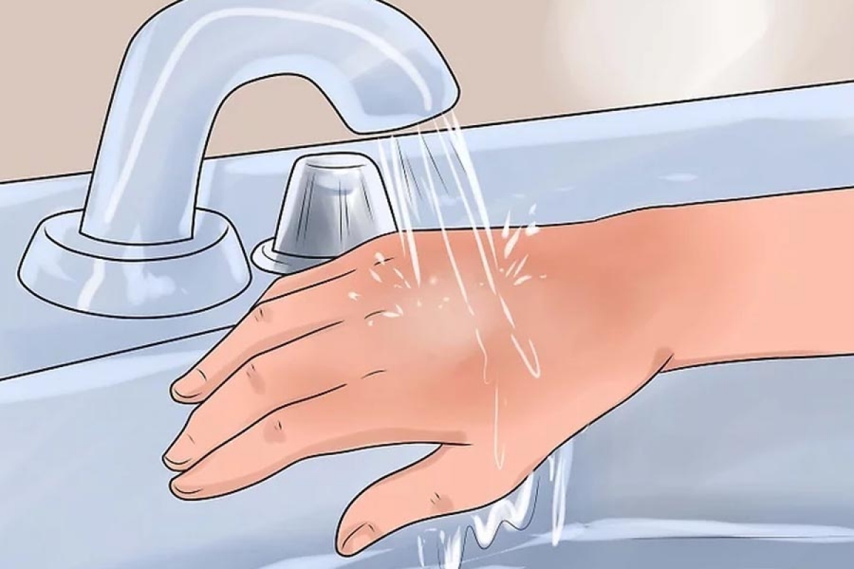 Ngay khi trẻ bị bỏng cần ngâm bộ phận bị bỏng (tay, chân) vào trong nước sạch, mát
