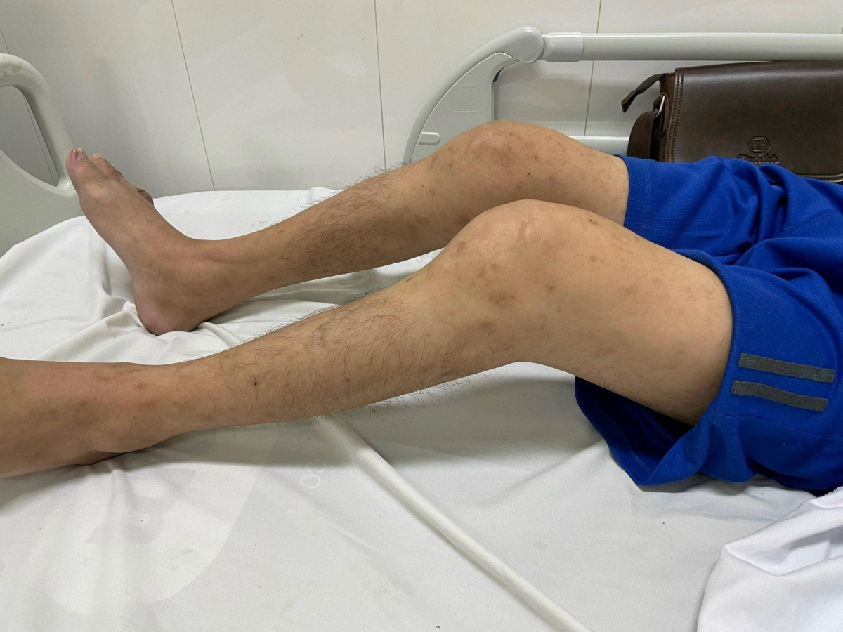 Bệnh nhân B.X.T bị biến dạng khớp trước mổ