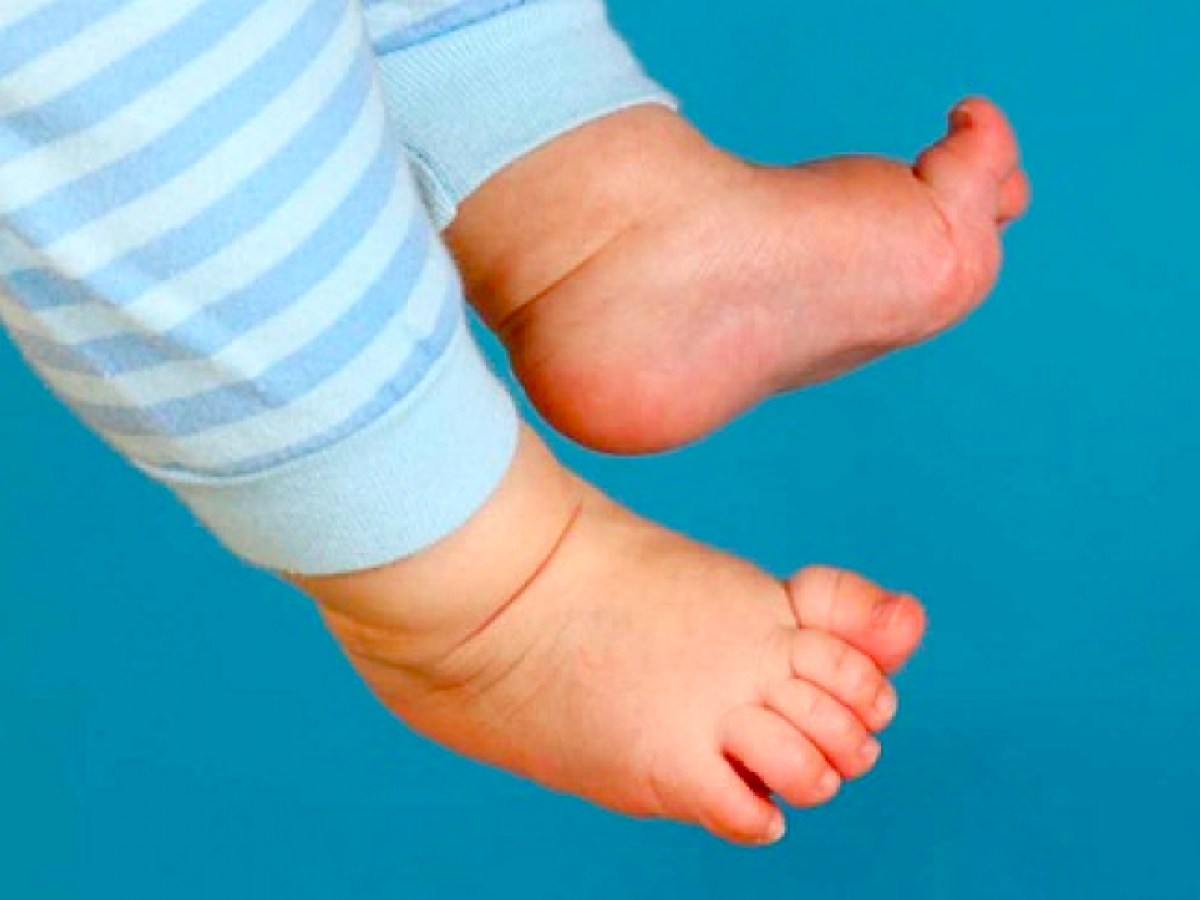 Một trong những dấu hiệu cha mẹ cần chú ý đó là sự chênh lệch của chi (chân)
