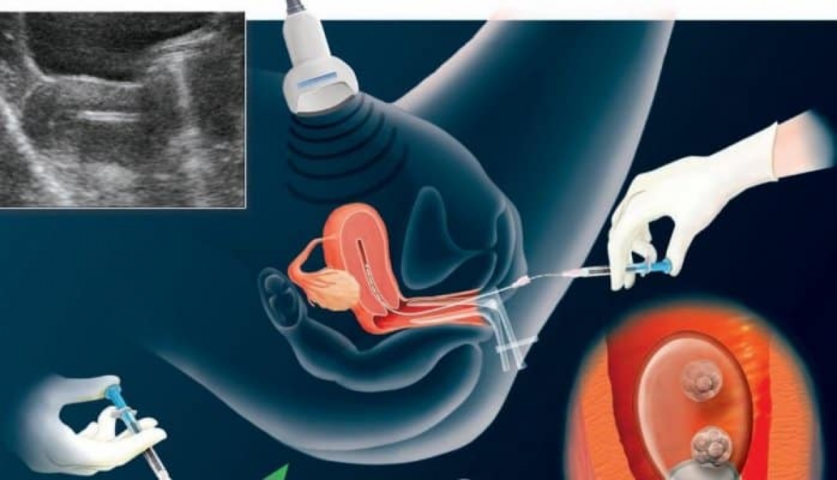 Các bác sĩ hút tinh trùng từ mào tinh rồi sau đó đi làm thụ tinh trong ống nghiệm.