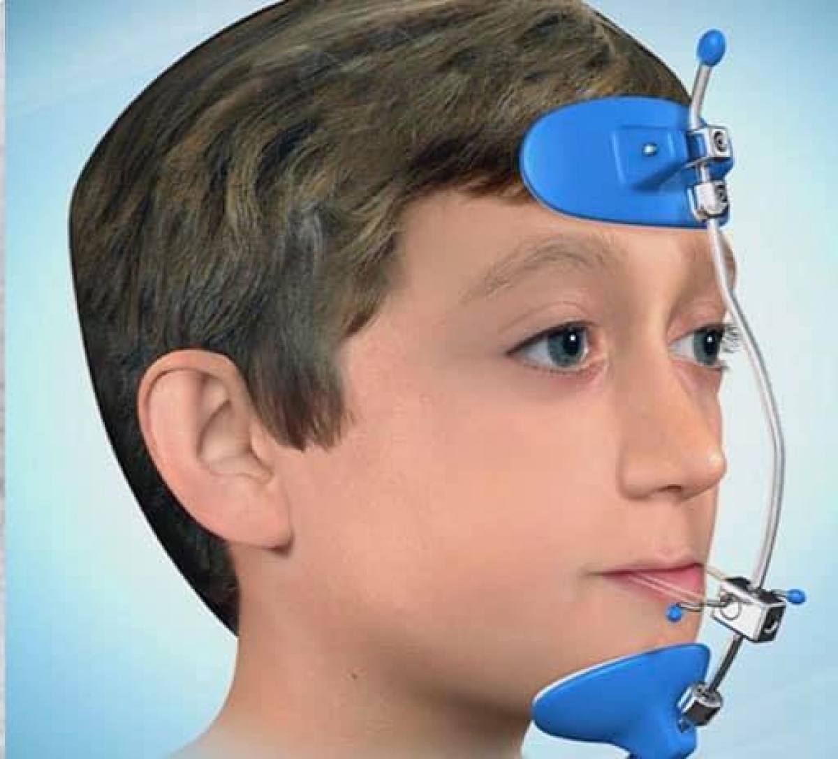 Facemask là 1 khí cụ chỉnh hình giúp phát triển xương hàm trên ra trước một cách hiệu quả 