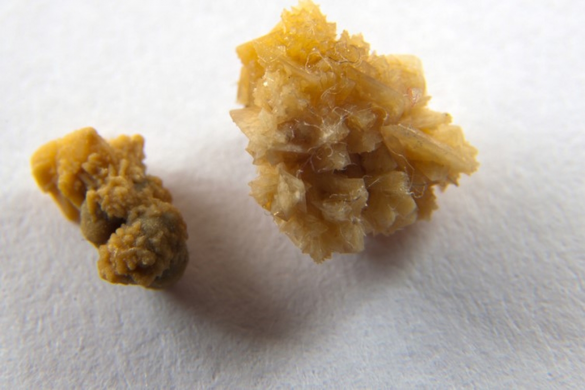 Sỏi san hô được lấy ra từ thận của 1 bệnh nhân