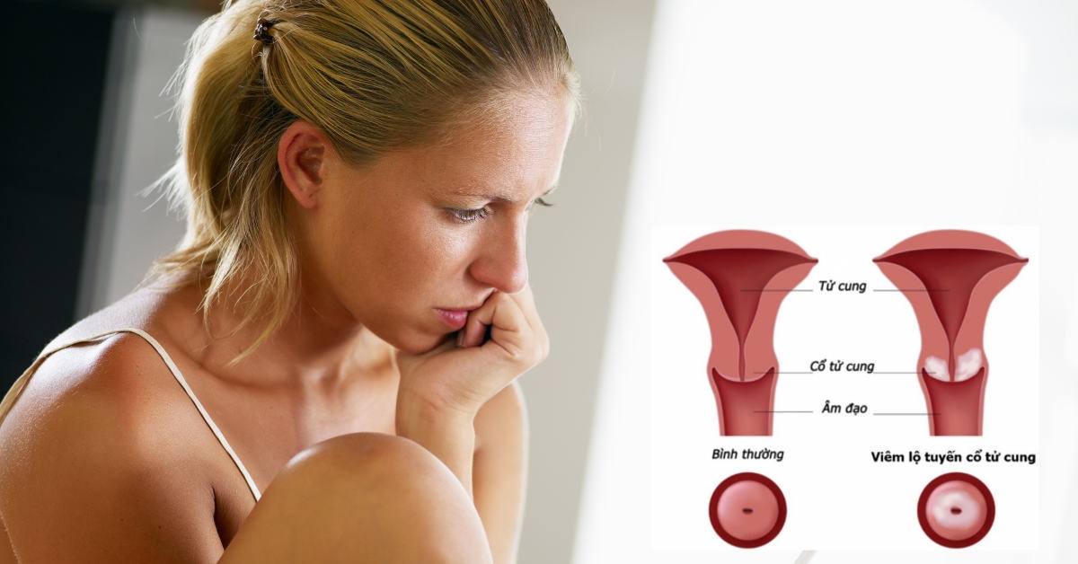 Các bác sĩ khuyến cáo chỉ điều trị khi lộ tuyến cổ tử cung trở thành vấn đề bệnh lý