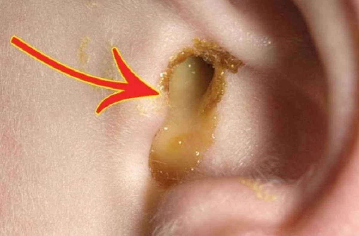 Hình ảnh trẻ bị viêm tai giữa