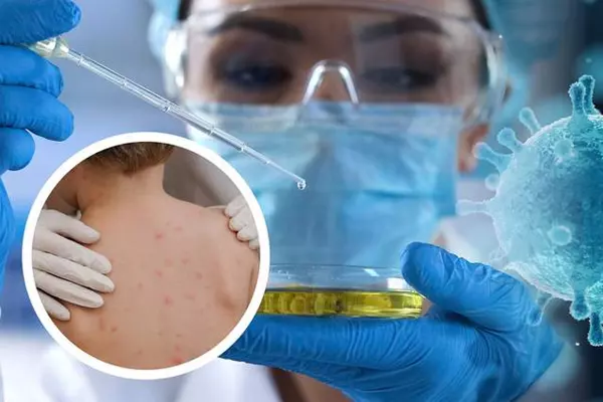 Bộ Y tế đã triển khai nhiều biện pháp quyết liệt nhằm không để dịch đậu mùa khỉ bùng phát