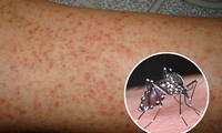hà nội phát hiện gần 140 ca mắc sốt xuất huyết hình 2