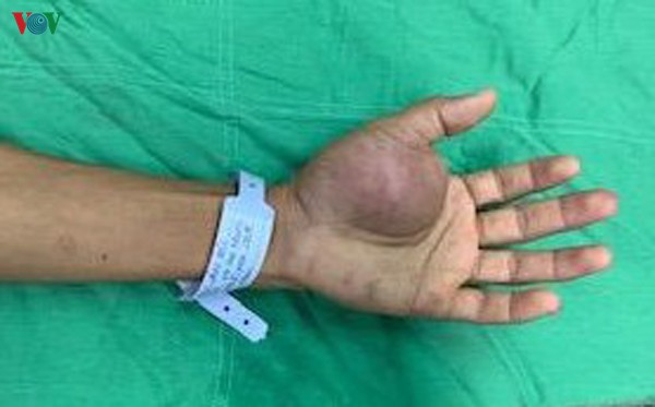 phau thuat thanh cong cho benh nhan bi buou mau vung ban tay hinh 1