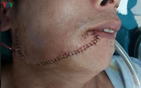 nguoi dan ong di rung bi trau huc rach mat hinh 1