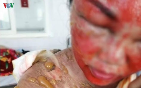 chong do ca am nuoc soi len dau khien vo bi bong nang hinh 1