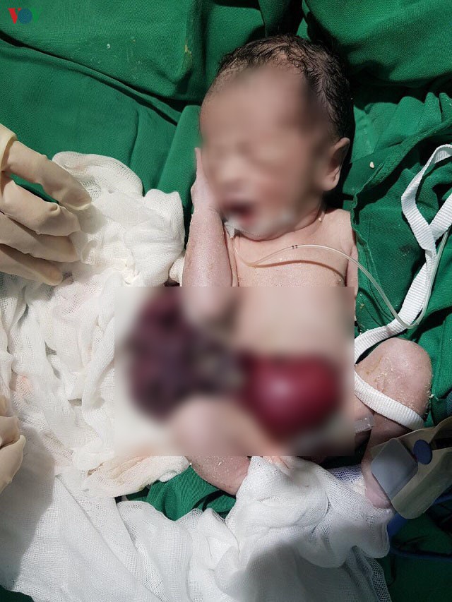 cuu song em be bi di tat bam sinh khien toan bo noi tang loi ra ngoai hinh 1