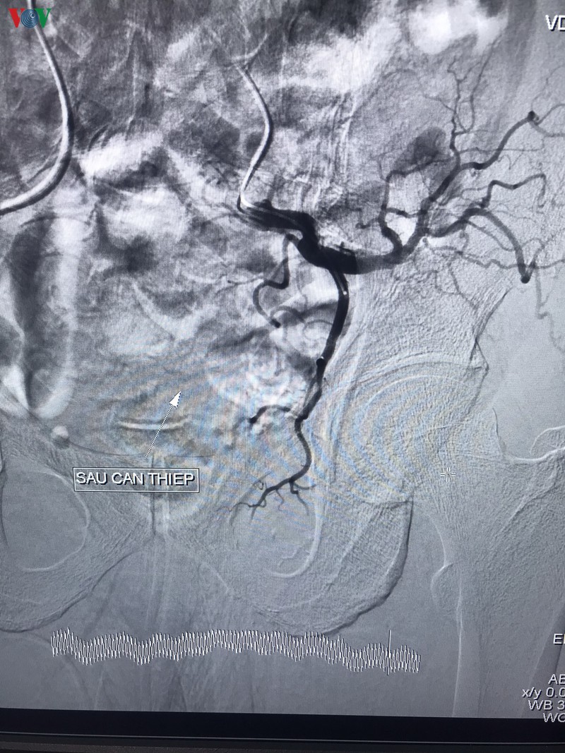 can thiep thanh cong benh nhan bi tieu ra mau nguy kich o can tho hinh 3