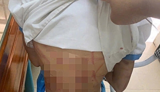 Cháu H.T.N.L. chi chít vết thương sau khi bị đánh.