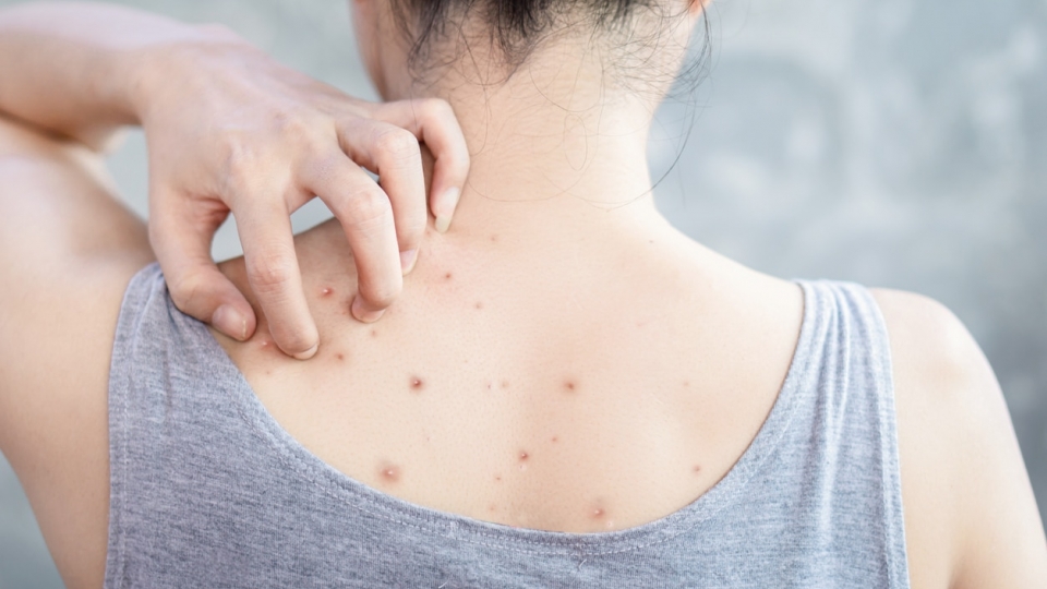 How-to-Get-Rid-of-Back-Acne.jpg