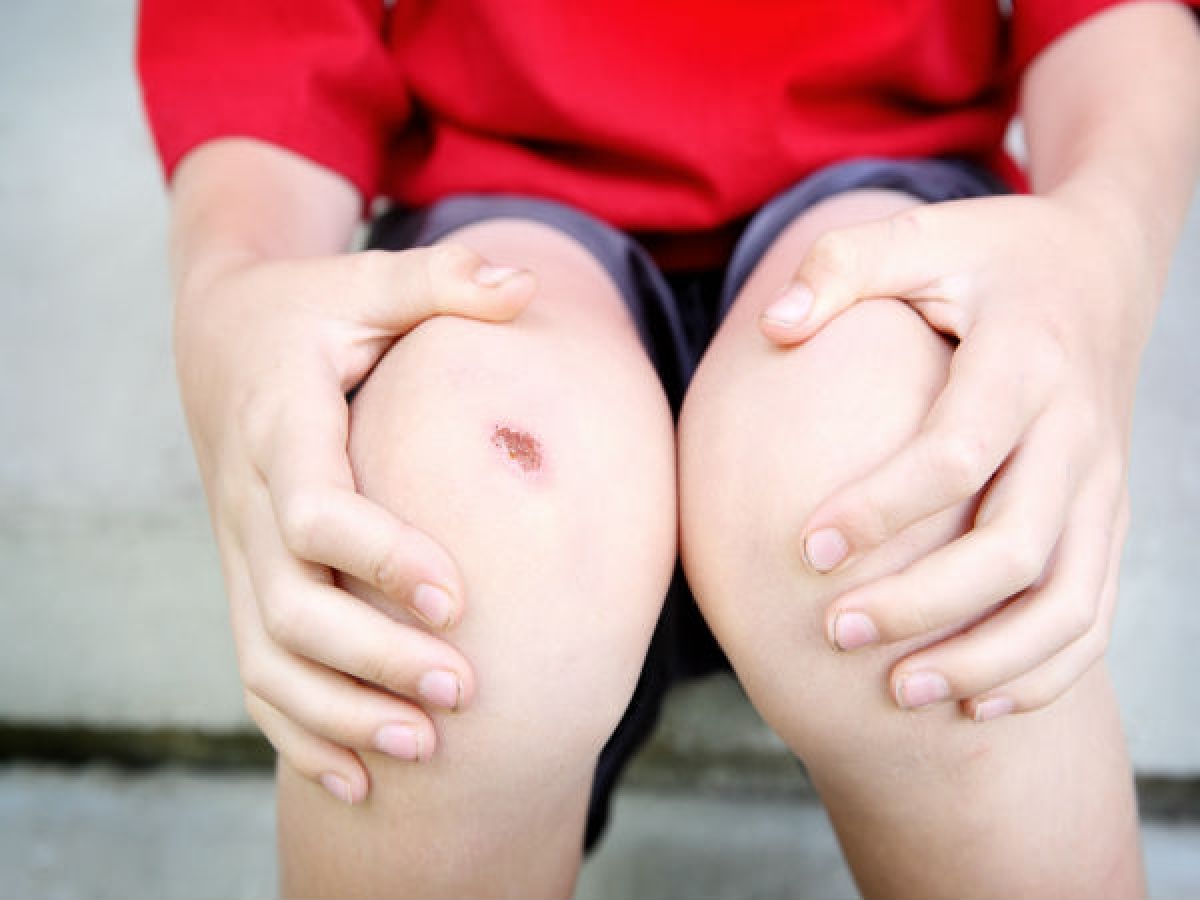 Không chườm đá trực tiếp lên vết thương hở: Chườm đá trực tiếp lên vết thương hở làm đông cứng các tế bào và mô dưới da, làm chậm lưu thông máu, gây tổn thương vĩnh viễn. Hãy sử dụng khăn hoặc vải bọc đá trước khi chườm vết thương.