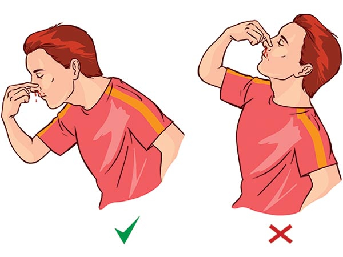 Không ngửa đầu ra sau khi bị chảy máu mũi: Ngửa đầu ra sau khi bị chảy máu mũi có thể khiến máu chảy ngược vào khí quản hoặc phổi, gây khó thở và nôn mửa. Thay vào đó, hãy ngả người về phía trước và bóp nhẹ sụn đầu mũi vài phút cho đến khi máu ngừng chảy.