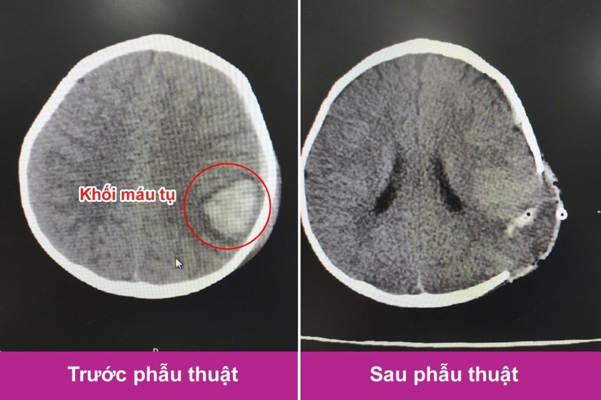 Hình ảnh trước và sau phẫu thuật lấy máu tụ nội sọ cho bé. (Ảnh: BVCC)