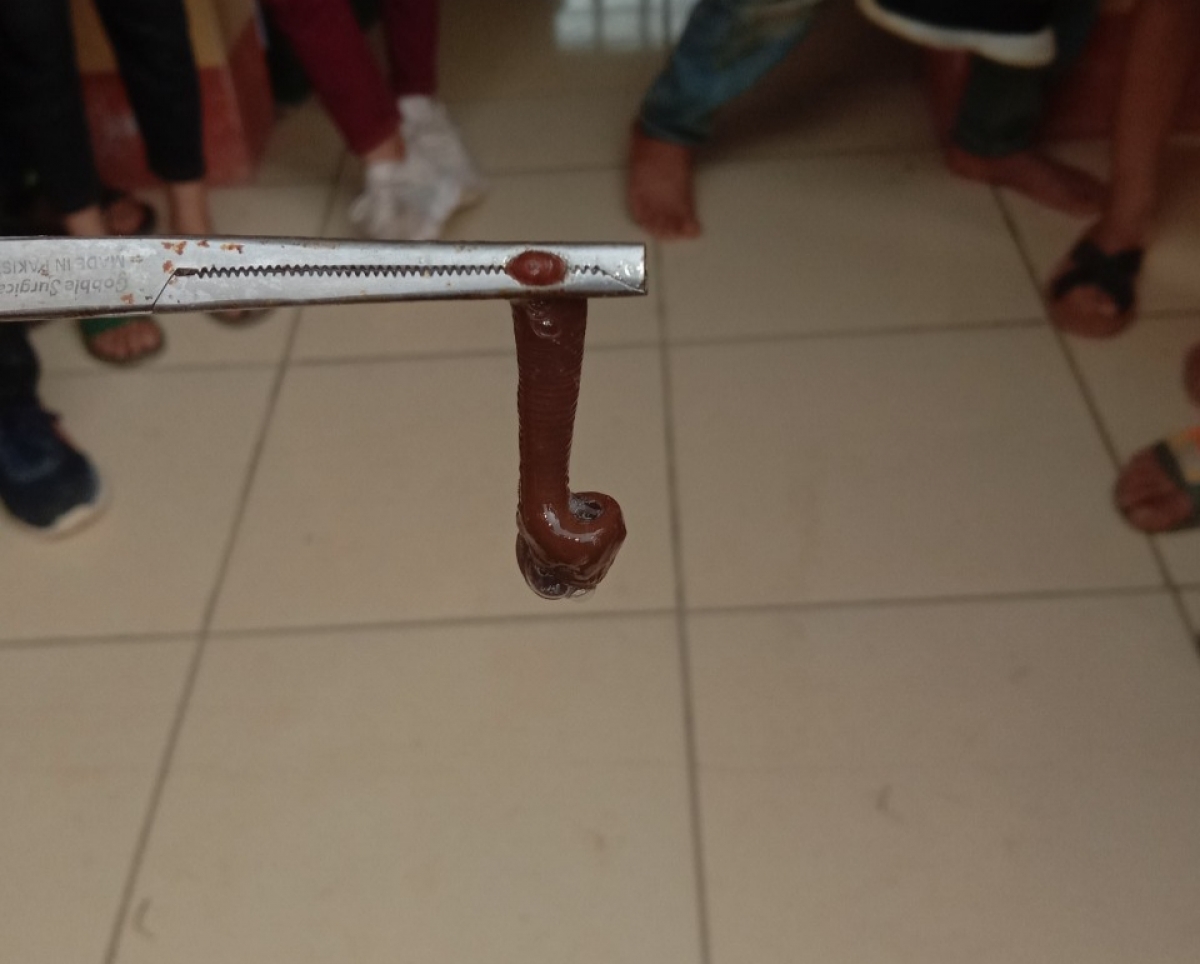 Hình ảnh con vắt dài 6cm gắp ra từ mũi bé trai.
