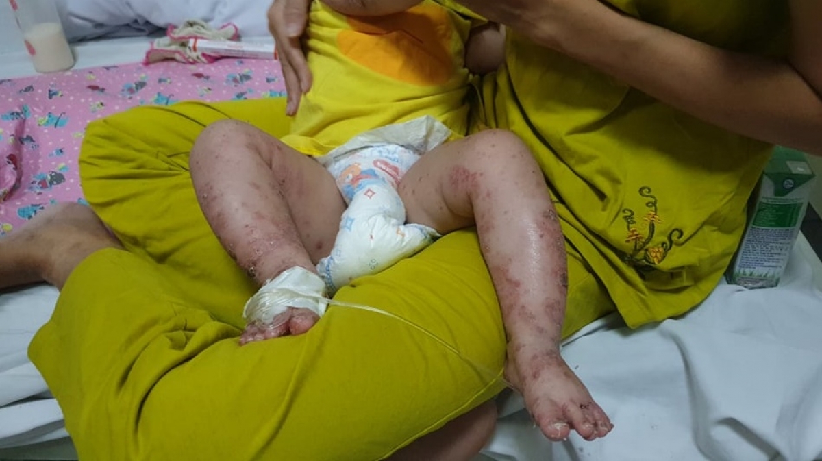 Trường hợp bệnh nhi mắc tay chân miệng kèm theo bội nhiễm da nặng sau khi bố mẹ tự ý mua thuốc chữa cho con.