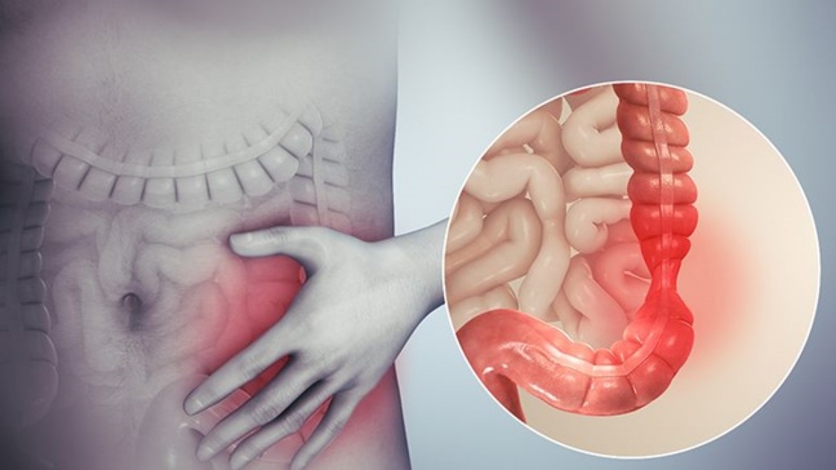 Cách giảm đau đại tràng nhanh.