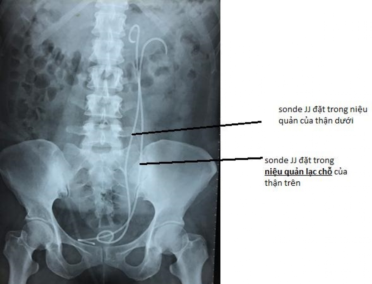 Hình chụp phim X-Quang hệ niệu sau phẫu thuật.