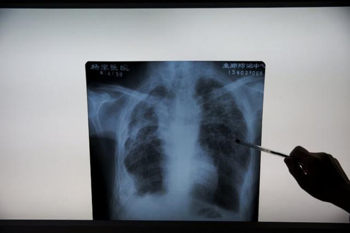 Thuật toán AI mới giúp phát hiện dấu hiệu COVID-19 nhanh hơn chuyên gia gấp 10 lần - Ảnh: REUTERS