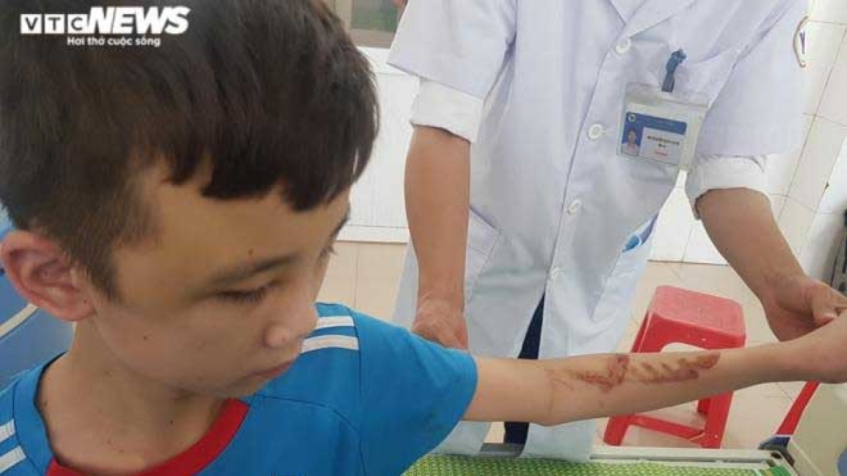 Cháu bé 14 tuổi - giúp việc tại quán bánh xèo miền Trung (xã Yên Trung, Yên Phong, Bắc Ninh) bị đánh đập dã man. (Ảnh: VTC News)