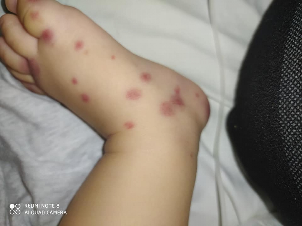 Chân bé D. xuất hiện những mảng xuất huyết tím đen, đối xứng nhau. (Ảnh: BVCC)