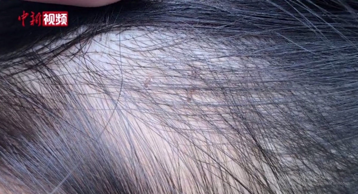Vết kim đâm trên đầu trẻ. Nguồn Chinanews.