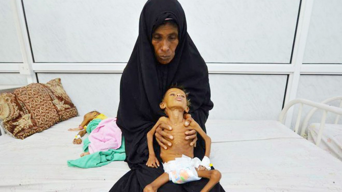 Nhiều trẻ em ở Yemen bị suy dinh dưỡng vì đói. (Ảnh: Reuters)
