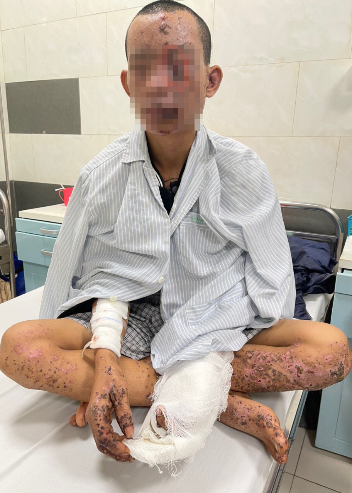 Dùng điện thoại khi đang sạc, nam thanh niên bị cháy sém toàn thân, nguy cơ mù cao.