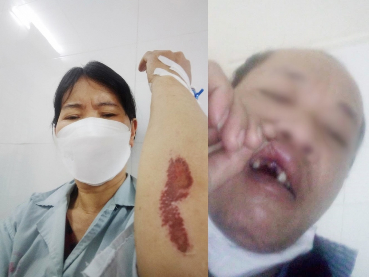 Cụm phó cụm dân cư số 5, xã Thọ Xuân, huyện Đan Phượng - bà Lê Thị L. (trái) cùng chồng bị đánh nhập viện.