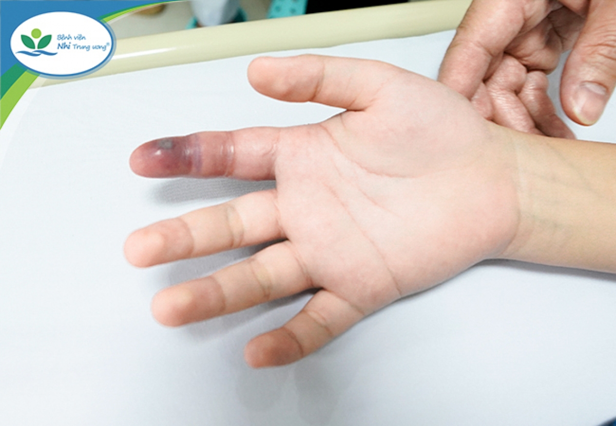 Ngón tay bị rắn cắn của bệnh nhi. (Ảnh: BV Nhi trung ương)