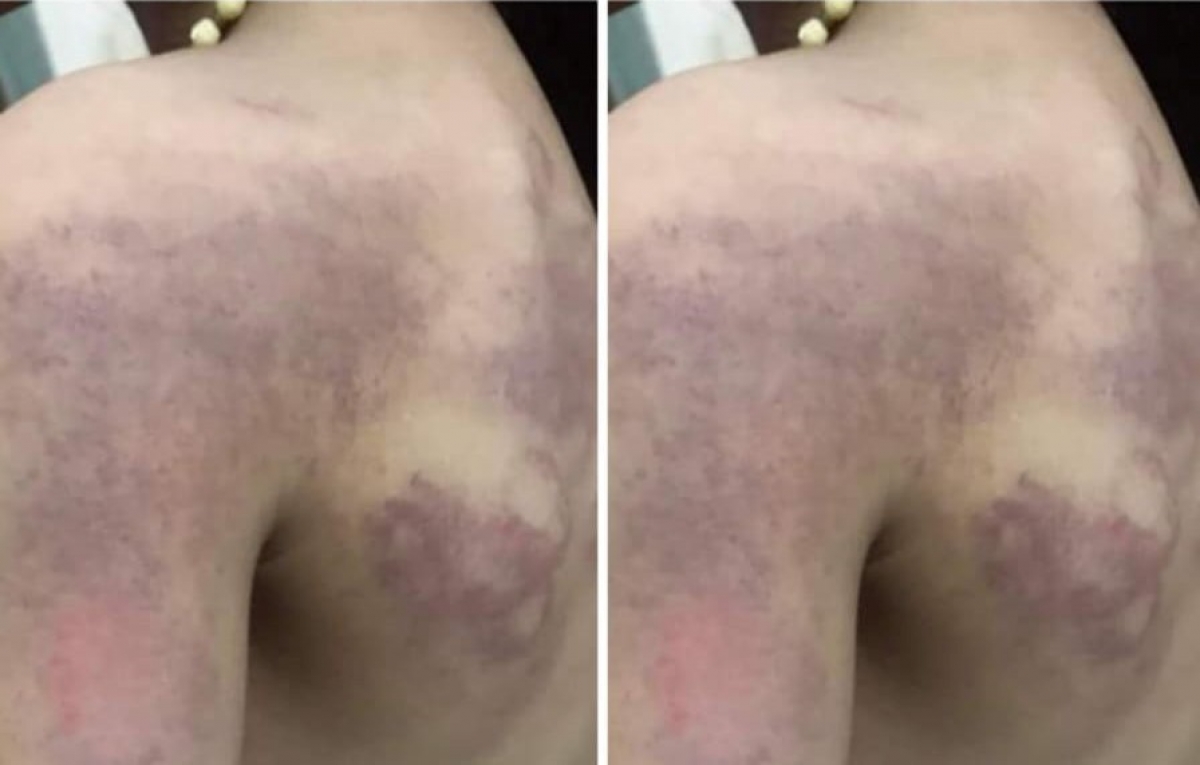 Những vết bầm tím trên vai, lưng cháu bé nghi bị cô giáo đánh.