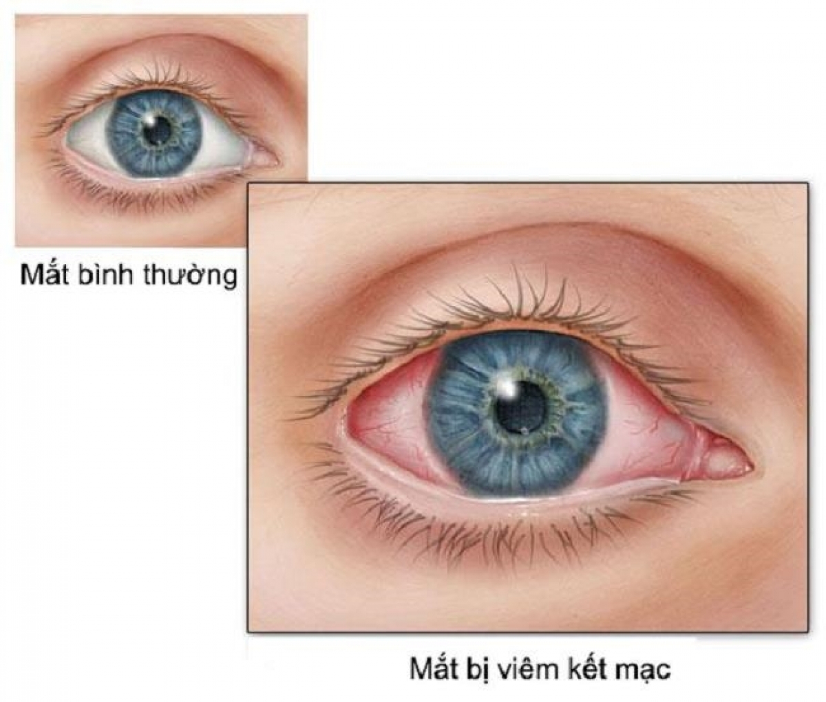 Khi thấy trẻ có những biểu hiện của viêm kết mạc (đau mắt đỏ) hậu COVID, cha mẹ nên đưa con đến gặp bác sĩ chuyên khoa Mắt để được thăm khám, chẩn đoán và can thiệp kịp thời. (Ảnh minh họa)