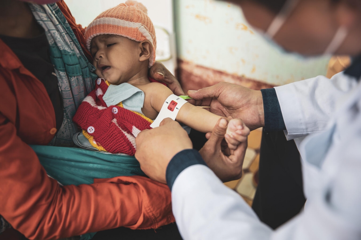 Trẻ em bị suy dinh dưỡng. (Ảnh: UNICEF)