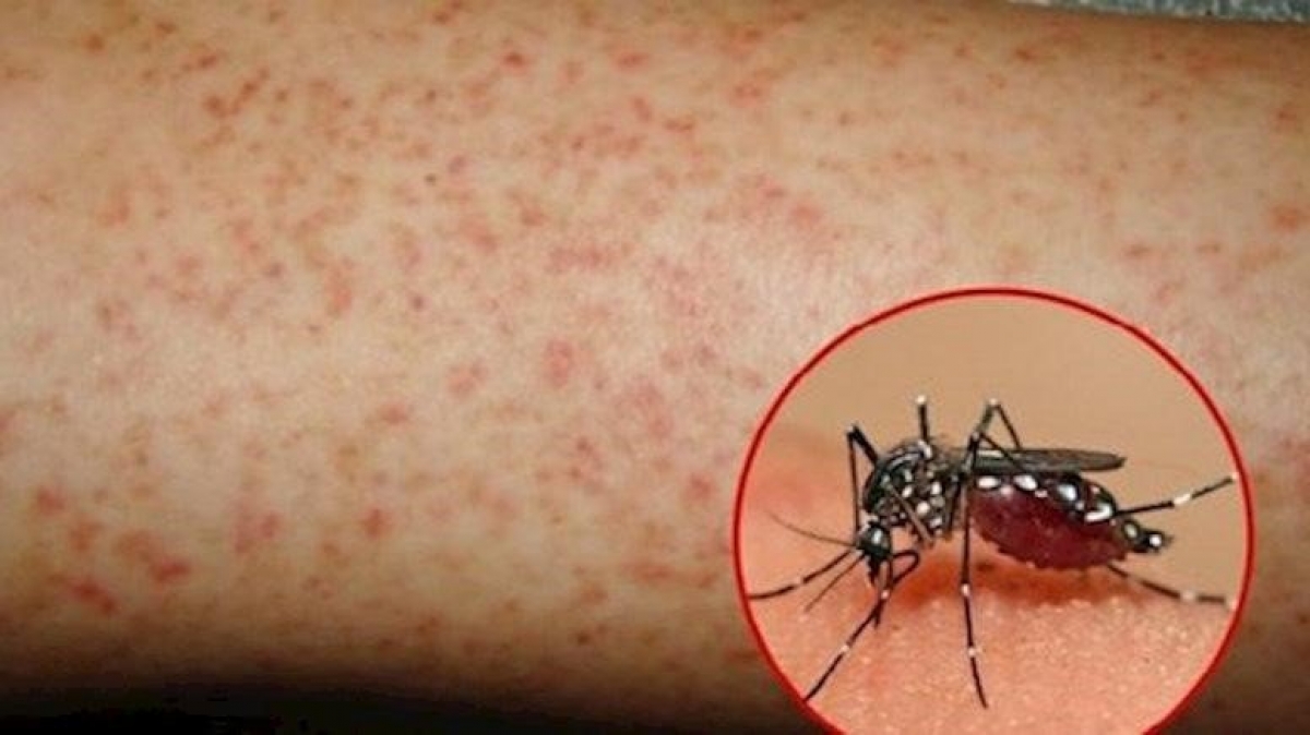 biến chủng sốt xuất huyết mới tại nga hình ảnh 1 bien chung sot xuat huyet moi tai nga hinh anh 1