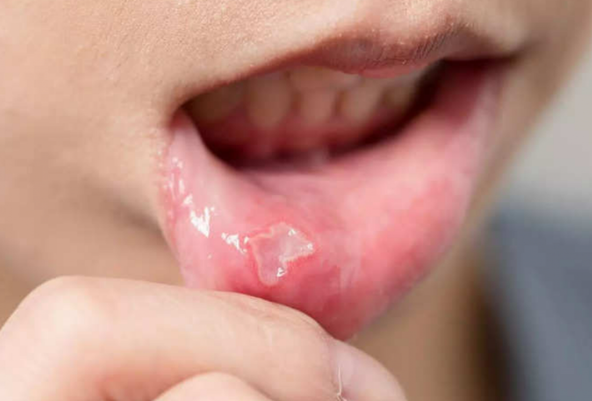 dấu hiệu này trên lưỡi chứng tỏ bạn thiếu vitamin b12 hình ảnh 1 dau hieu nay tren luoi chung to ban thieu vitamin b12 hinh anh 1
