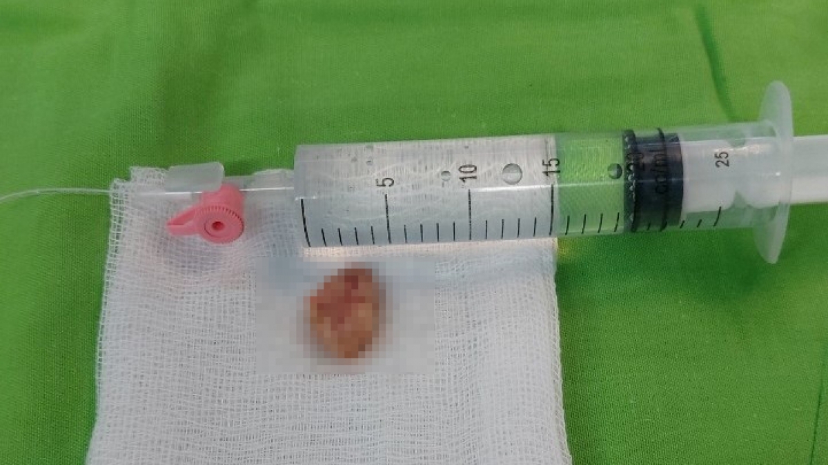bệnh viện Đa khoa tỉnh yên bái thực hiện ca bóc u tủy sống rất khó hình ảnh 1 benh vien Da khoa tinh yen bai thuc hien ca boc u tuy song rat kho hinh anh 1