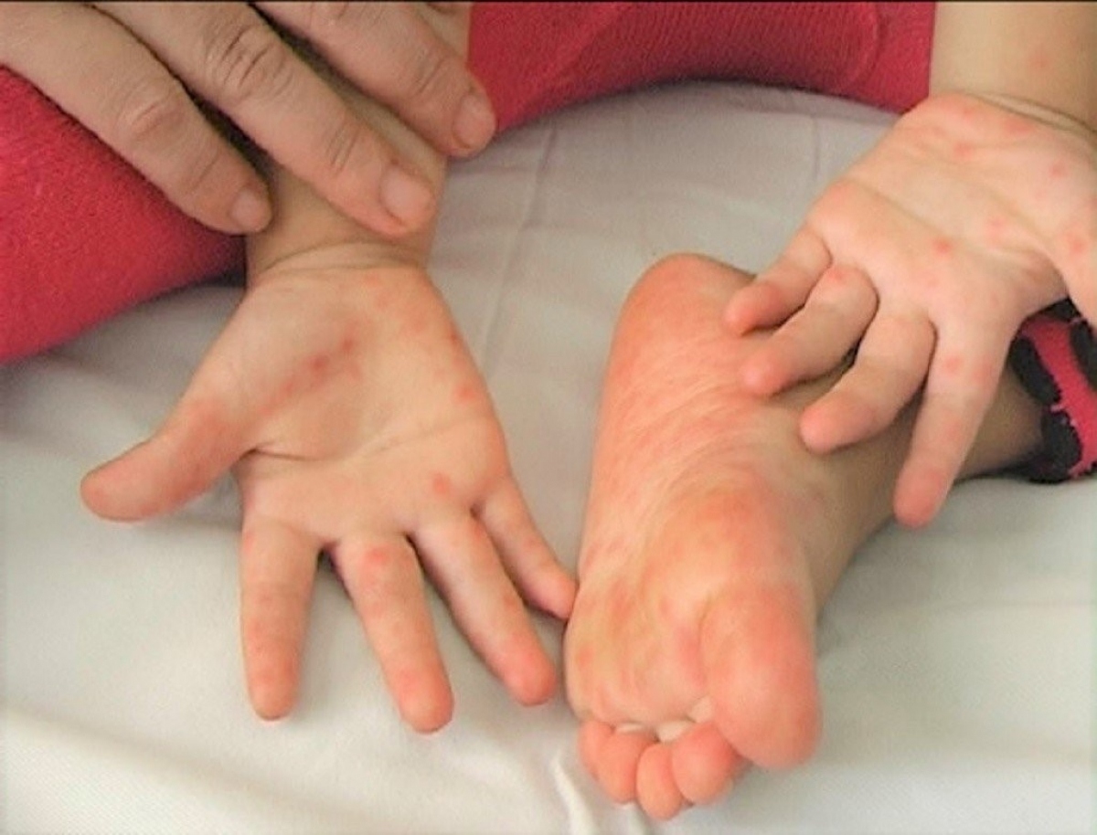 những lưu ý khi phòng bệnh cho trẻ lúc giao mùa thu đông hình ảnh 1 nhung luu y khi phong benh cho tre luc giao mua thu dong hinh anh 1