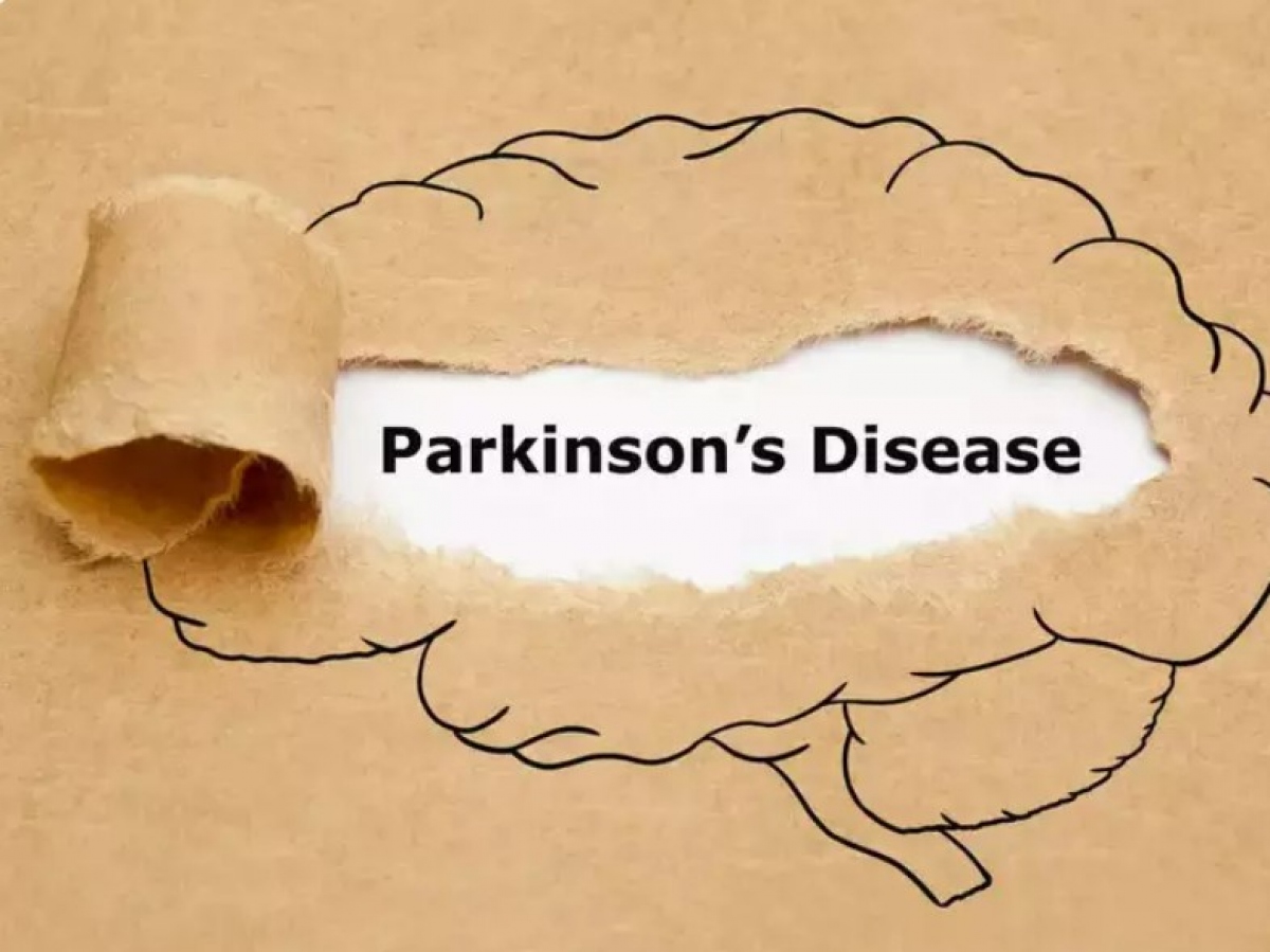 Đừng bỏ qua các dấu hiệu cảnh báo sớm của bệnh parkinson hình ảnh 1 Dung bo qua cac dau hieu canh bao som cua benh parkinson hinh anh 1