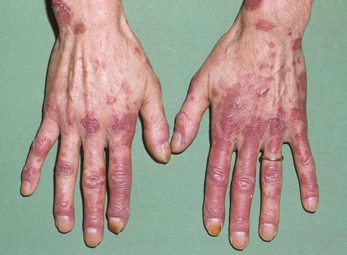 dùng đơn thuốc cũ, bệnh nhân lupus ban đỏ phải nhập viện cấp cứu hình ảnh 1 dung don thuoc cu, benh nhan lupus ban do phai nhap vien cap cuu hinh anh 1