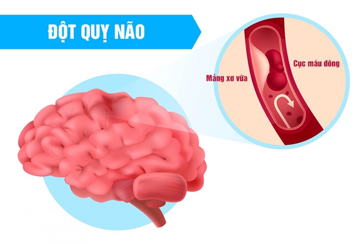 quy tắc f.a.s.t giúp nhận diện sớm cơn đột quỵ hình ảnh 1 quy tac f.a.s.t giup nhan dien som con dot quy hinh anh 1