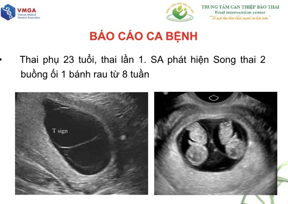 công bố ca song thai cùng trứng cực kỳ đặc biệt, lần đầu ghi nhận tại việt nam hình ảnh 1 cong bo ca song thai cung trung cuc ky dac biet, lan dau ghi nhan tai viet nam hinh anh 1
