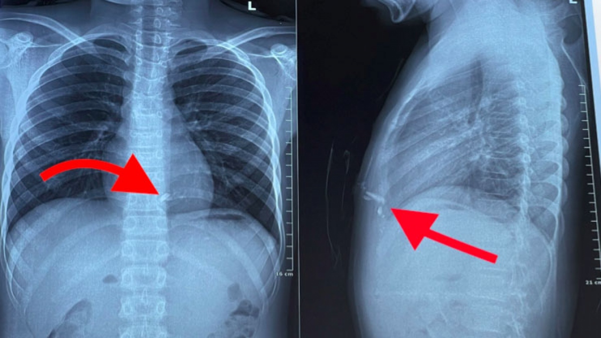 nam sinh ton thuong tim, bong khap mat va tay chan vi tu che phao hinh anh 1
