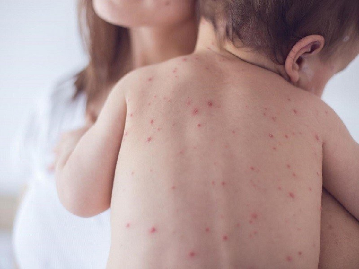 ghi nhận 2 ổ dịch thủy đậu ở Đắk lắk hình ảnh 1 ghi nhan 2 o dich thuy dau o Dak lak hinh anh 1