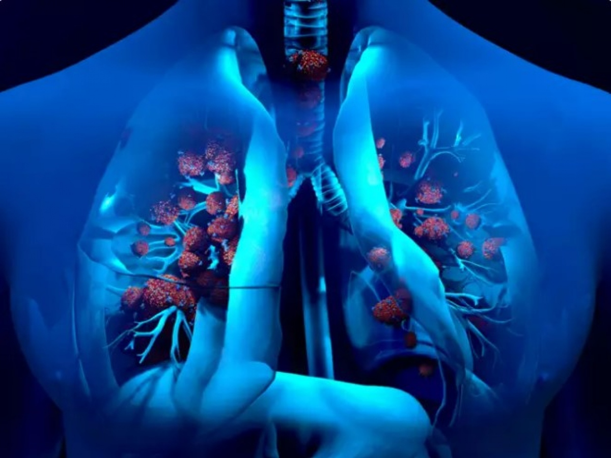 Nhiễm trùng đường hô hấp: Cúm và các bệnh nhiễm virus đường hô hấp khác gia tăng do khí hậu ẩm ướt. Các triệu chứng thường là cảm lạnh, ho, sốt và các triệu chứng khác như đau đầu. Chuyên gia cho biết, tình trạng này thường trở nên tồi tệ hơn ở những bệnh nhân bị dị ứng và hen suyễn. Các phòng ngừa gồm tránh nơi đông người, đeo khẩu trang đúng cách, rửa tay và vệ sinh, tiêm phòng cúm hàng năm để giảm nguy cơ nhiễm trùng
