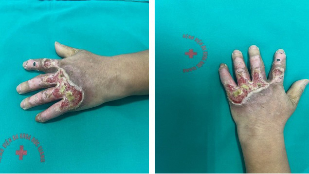 Nhiễm trùng bàn tay bị bỏng do trước đó điều trị sai cách