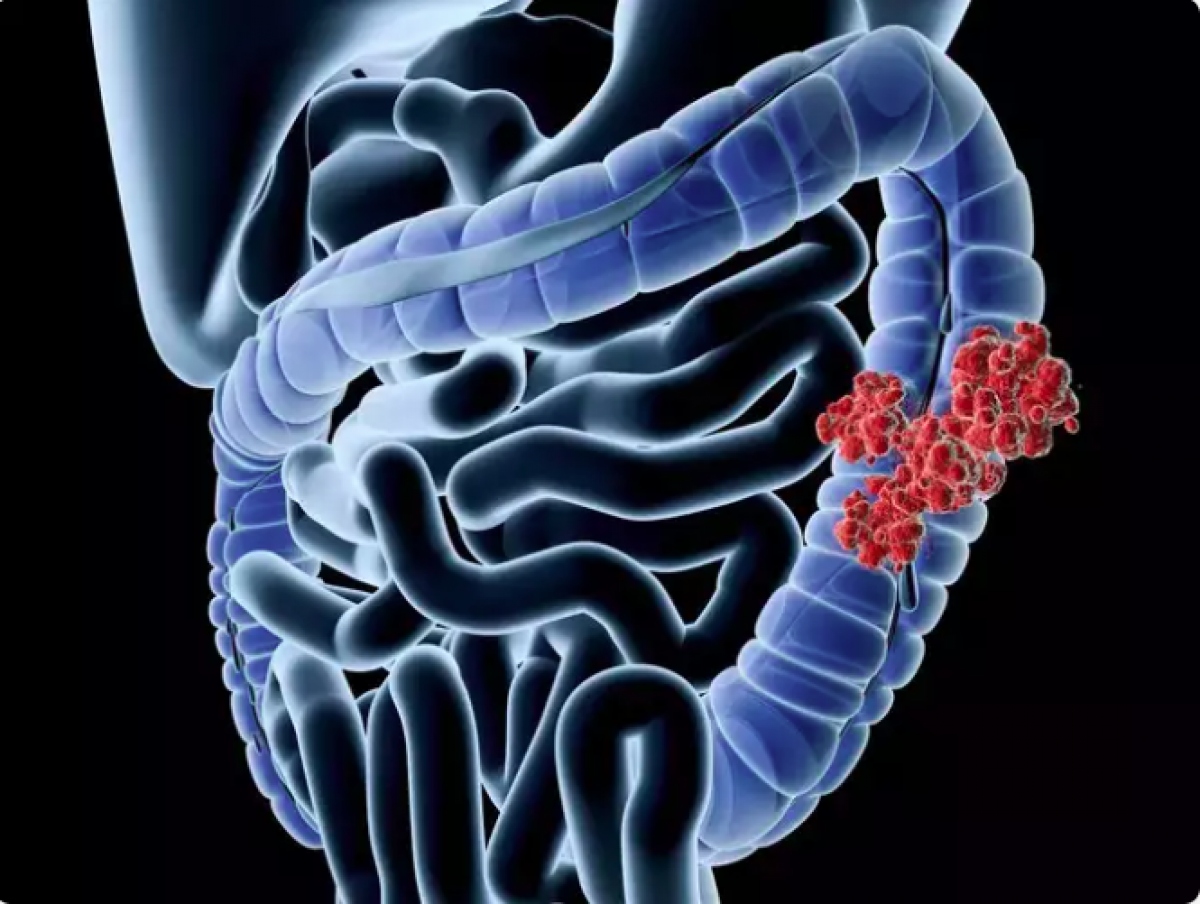 Thiếu folate và ung thư ruột: Một nghiên cứu được công bố trên Annals of Oncology năm 2011 đã thử nghiệm việc sử dụng folate trên hơn 5.000 người, trong đó có một số người bị ung thư. Nghiên cứu trong khoảng thời gian 8 năm.