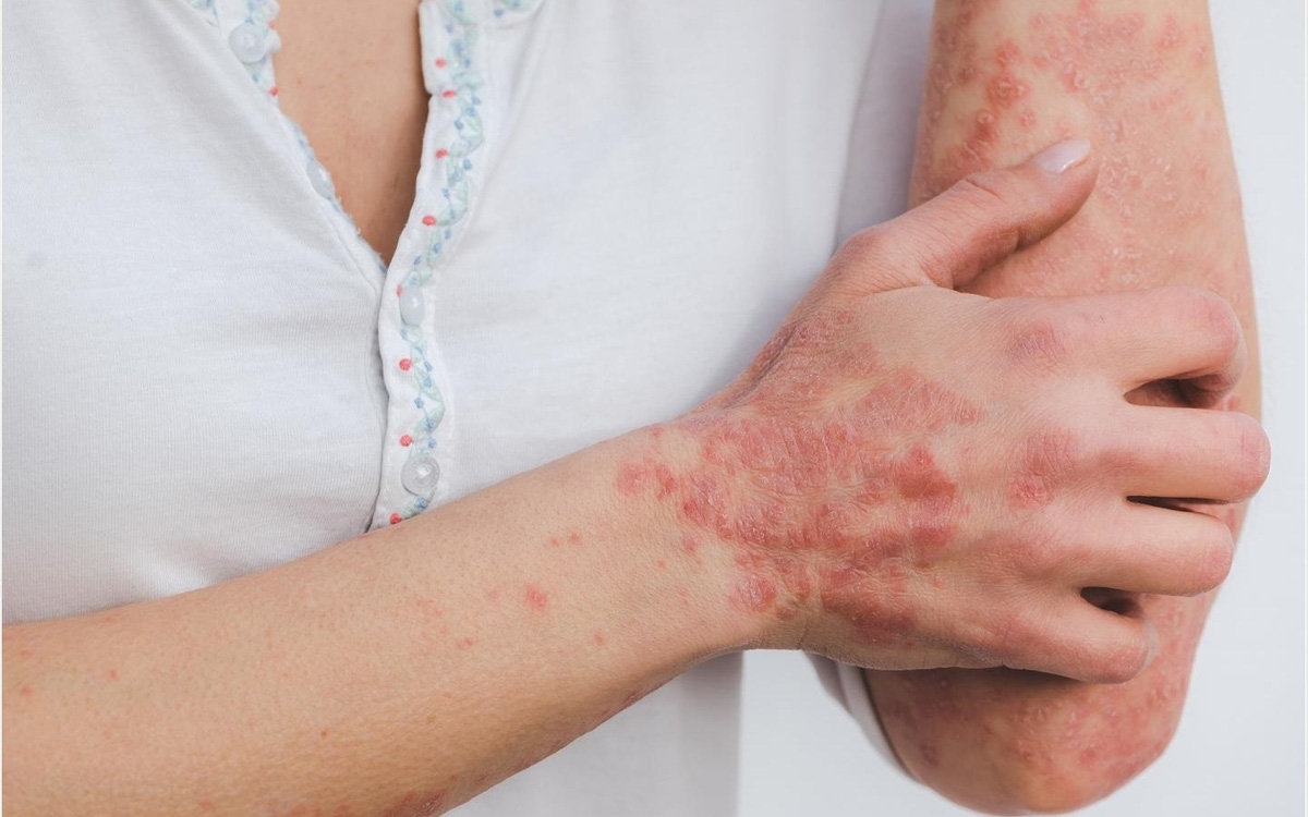 Biến chứng về da: Người bệnh tiểu đường có lượng đường trong máu cao làm hệ miễn dịch suy yếu, tăng khả năng nhiễm trùng da nếu vi khuẩn xâm nhập. Vết cắt, phồng rộp hoặc vết nứt trên da sẽ tạo điều kiện cho vi khuẩn xâm nhập vào cơ thể gây nguy cơ nhiễm trùng da, ngứa, viêm nang lông.